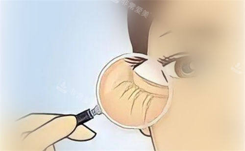 眼部细纹放大展示图.jpg