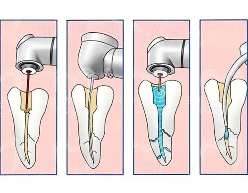 根管治疗步骤
