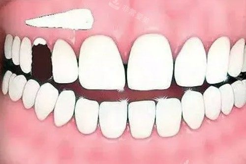 牙齿缺损卡通图