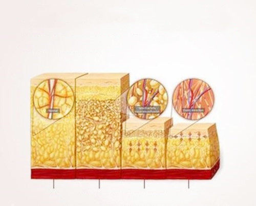 吸脂卡通图展示