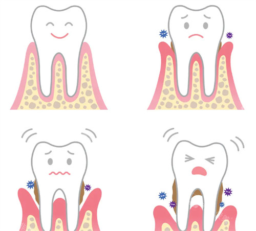 牙齿松动解决办法