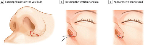 鼻翼手术前后对比图
