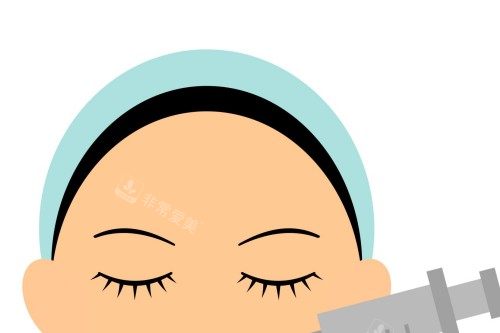 面部注射示意图