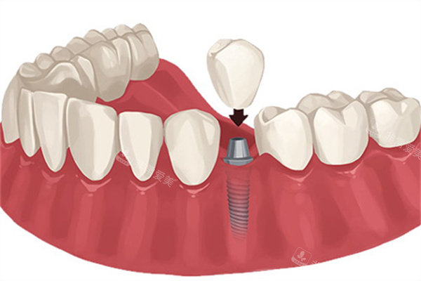 种植牙安装牙冠示意图