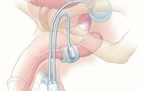 男性私密整形勃起治疗卡通示意图 男性私密整形勃起治疗卡通示意图