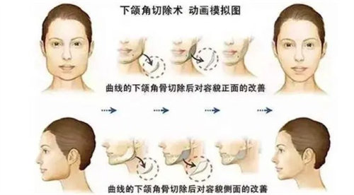 下颌角整形对比 下颌角整形对比