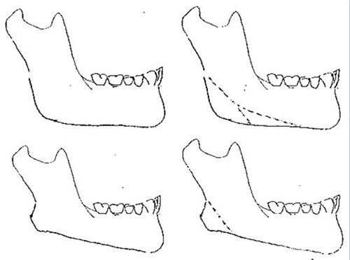 下颌角整形多次截骨示意图 下颌角整形多次截骨示意图
