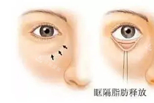 内切法眶隔脂肪释放 内切法眶隔脂肪释放