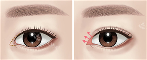 开内眼角的位置图解 开内眼角的位置图解