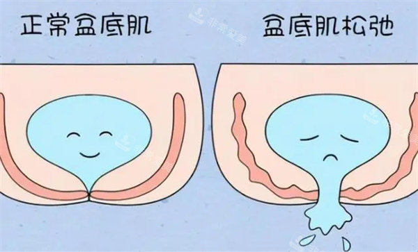 盆底肌修复图片