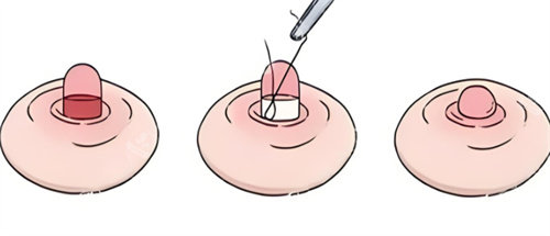 乳头缩小手术