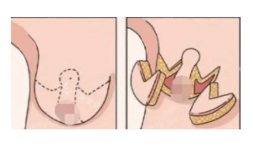 倒T法（标准乳房缩减术）展示