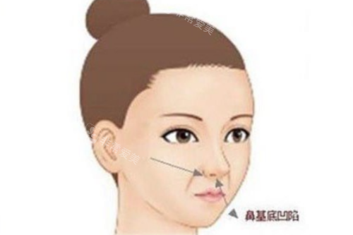 鼻基底凹陷