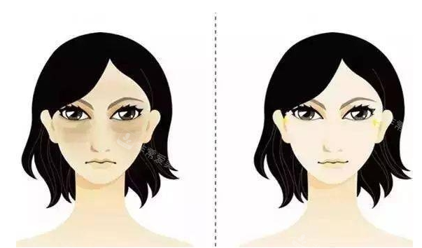 泪沟黑眼圈前后对比示意图 泪沟黑眼圈前后对比示意图