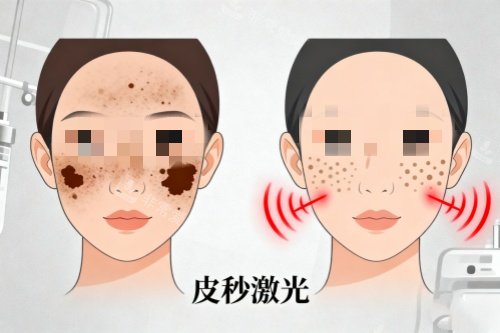 脸部做皮秒激光祛斑卡通图 脸部做皮秒激光祛斑卡通图