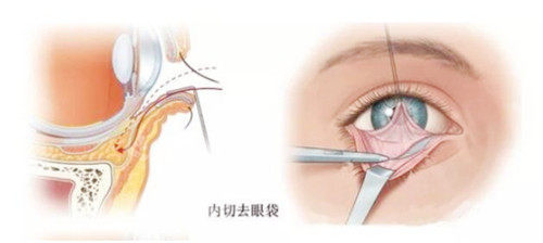 去眼袋手术图示