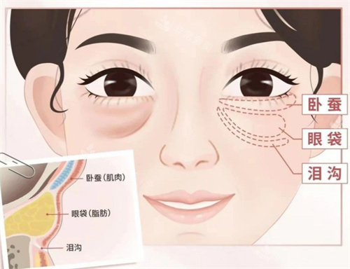 眼袋位置卡通图