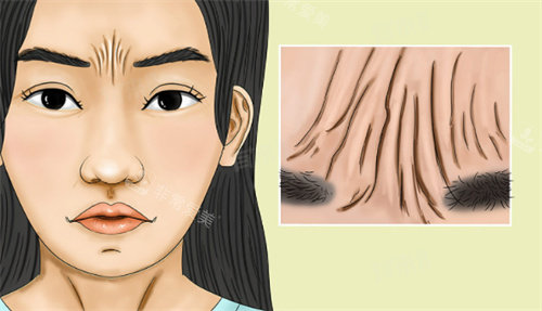 李广学川字纹手术费用表：真皮填充1.8万元起、内窥镜去川字纹术35000元起、额肌瓣下调固定术28000元起