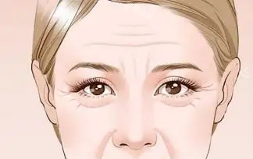 川字纹显老示意图