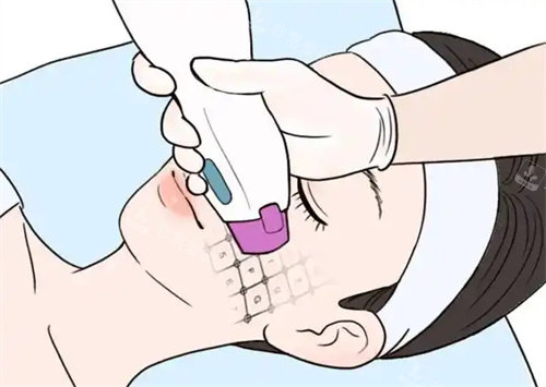 面部热玛吉卡通图片