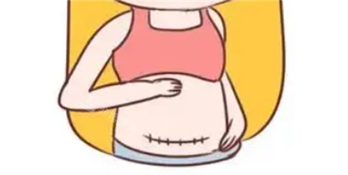 腹部疤痕