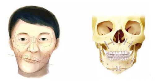 正頜手術(shù)對(duì)比圖