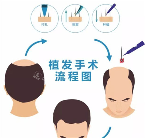 植發(fā)手術(shù)流程圖解