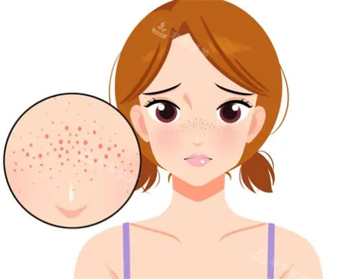 祛斑卡通图片