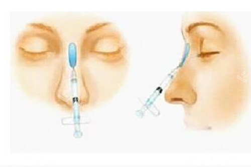 玻尿酸美容填充鼻梁示意图 玻尿酸美容填充鼻梁示意图