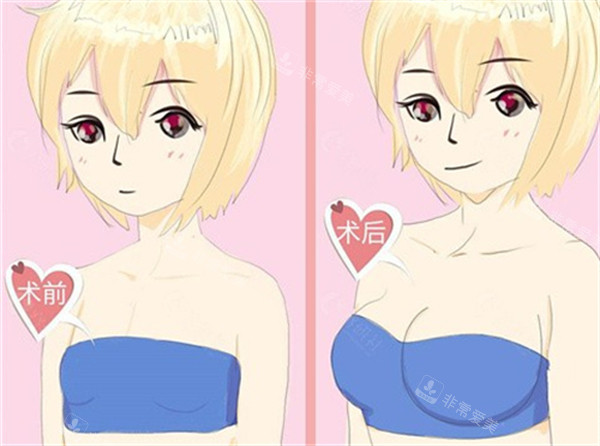隆胸前后对比图 隆胸前后对比图