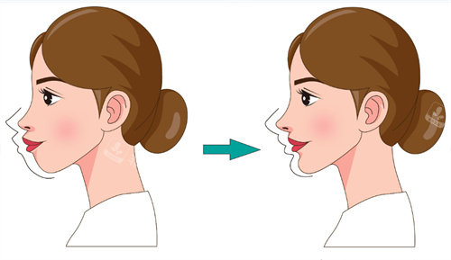 牙齿矫正前后对比卡通图