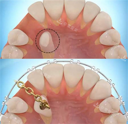 单颗牙齿牵引