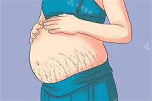 腹部妊娠纹