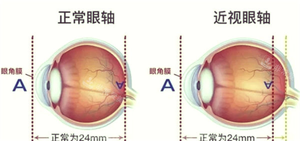 近视眼前后对比‘