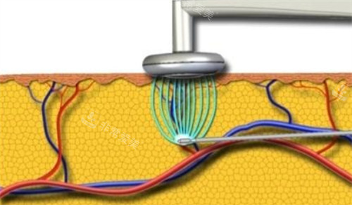 吸脂儀器 吸脂儀器