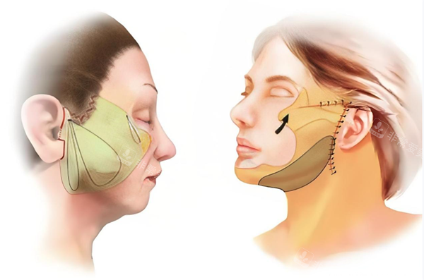 面部提升手術(shù)展示廳