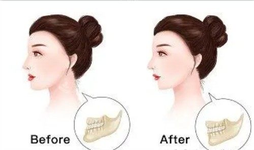 正颌手术后的成效图片 正颌手术后的成效图片