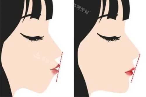 正颌手术前后的对比图 正颌手术前后的对比图