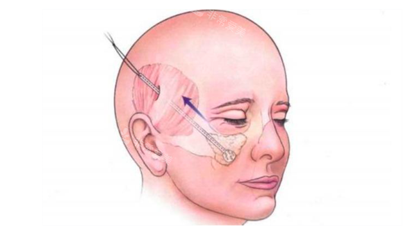 面部拉皮手术展示图