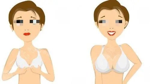 假體隆胸術后示意圖