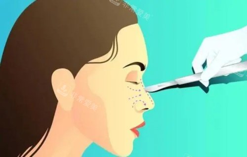 隆鼻失败修复示意图 隆鼻失败修复示意图