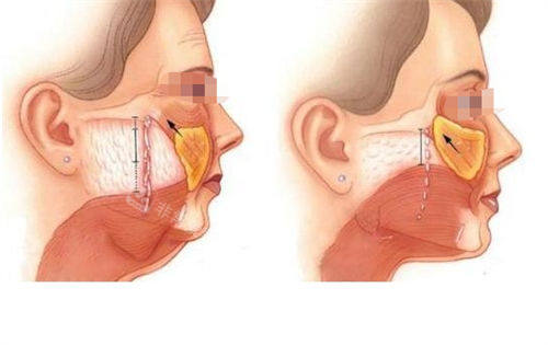 拉皮手术皮下组织切面对比展示图