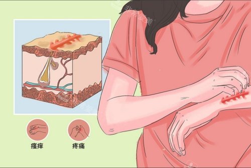 疤痕增生引起的癥狀示意圖