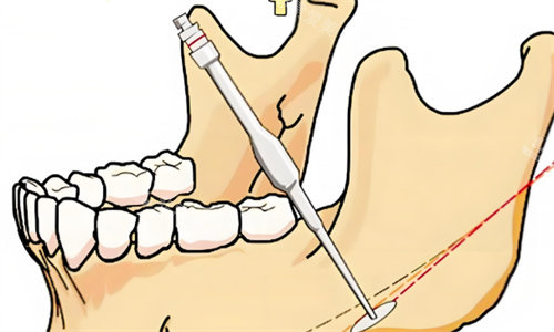 下颌角手术过程 下颌角手术过程