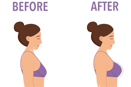 隆胸卡通图 隆胸卡通图