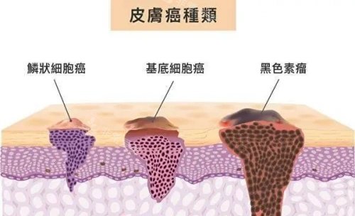 皮肤癌结构示意图