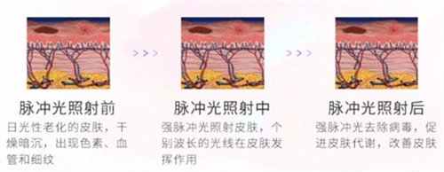 光子嫩肤对比 光子嫩肤对比