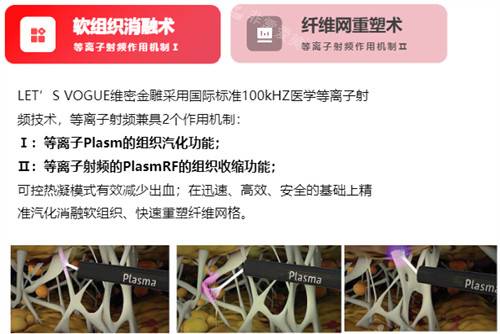 维密金雕原理介绍