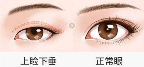 上瞼下垂手術(shù) 上瞼下垂手術(shù)