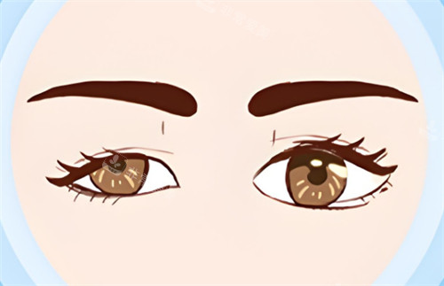 上瞼下垂一大一小眼 上瞼下垂一大一小眼
